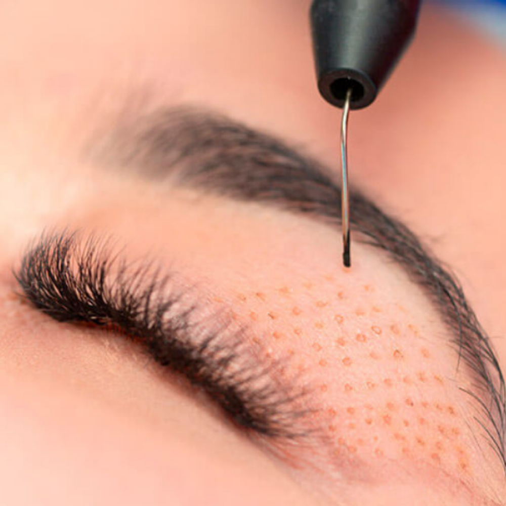 Plasma Pen at Skyn Esthetics INC. in Boca Raton, FL