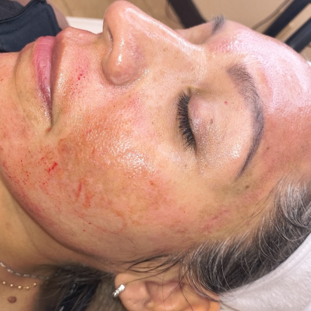 Microneedling at Elevate Beauty Bar Aesthetic & Wellness Spa in McAllen, TX