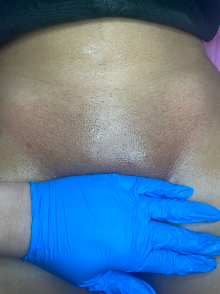 Vajacial with Light therapy at Aestheticbylola in Bronx, NY