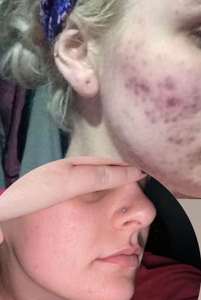 Acne Facial at Get Glowin Esthetics in Parma, ID