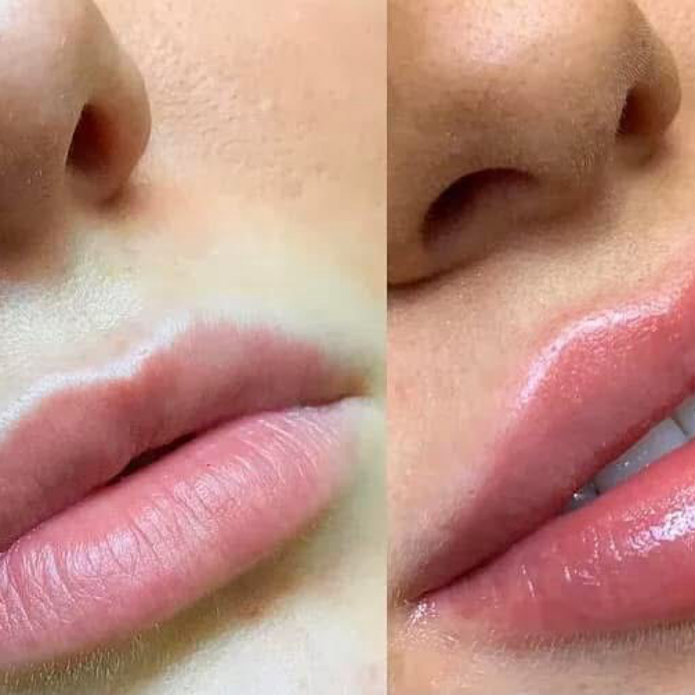 July Special-Mini Lip Fill at Unveiled Beauty Aesthetic Studio in Converse, TX