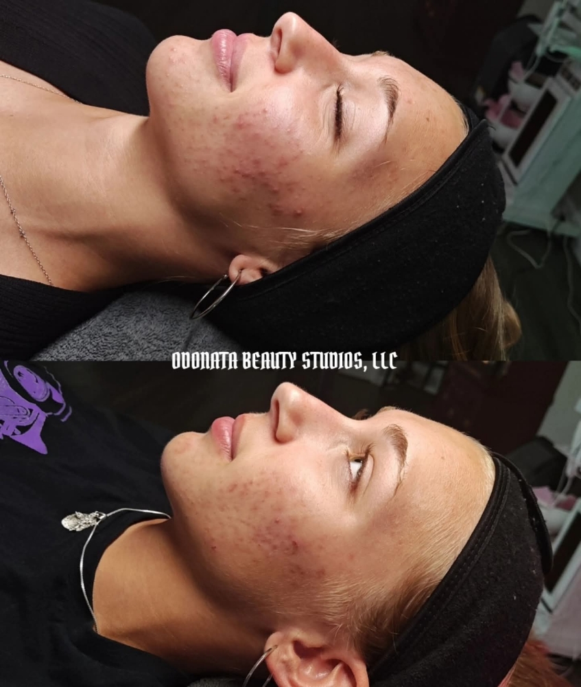 Face Reality Acne Bootcamp Consult