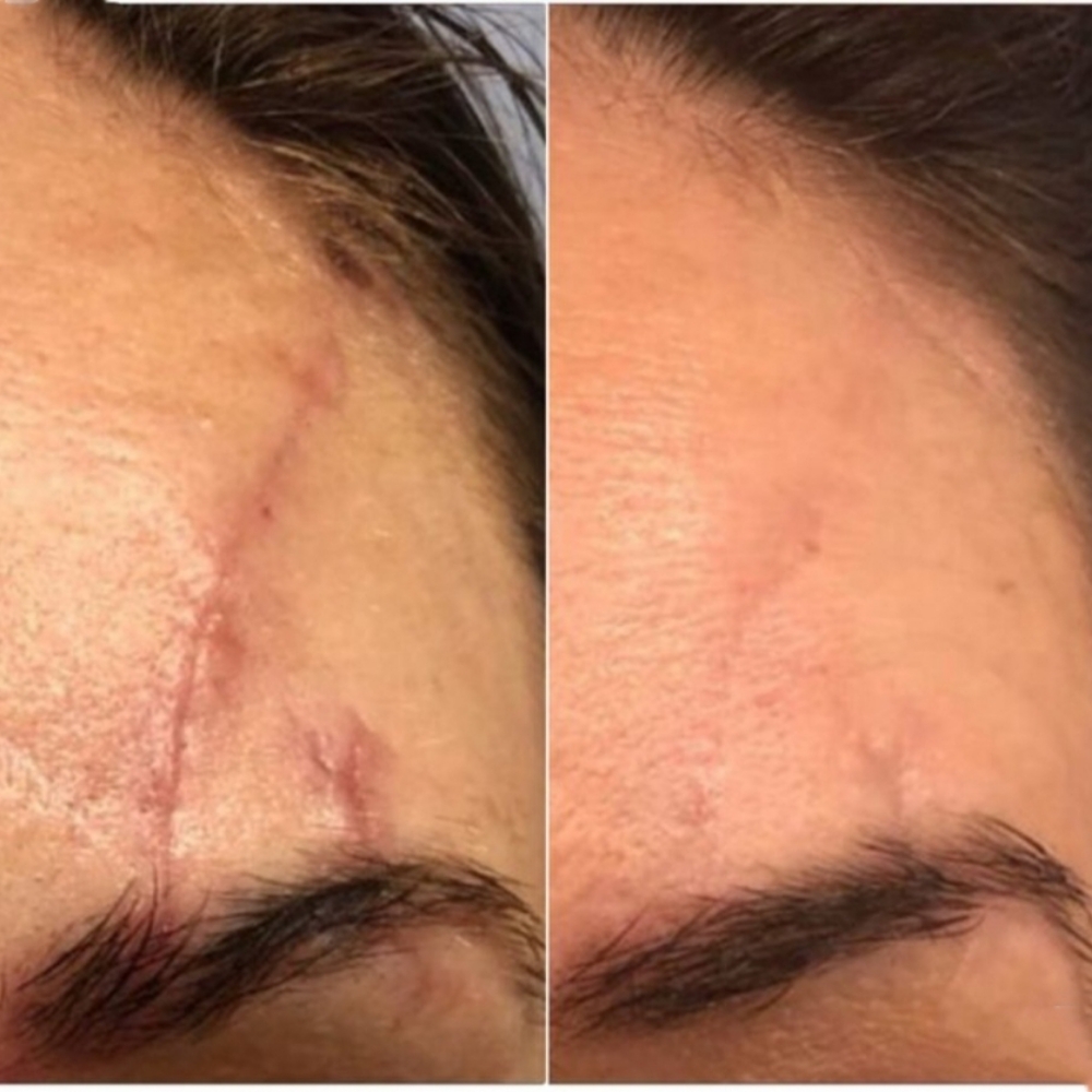 Scar Camouflage at BeautyPlanetbyBarbie in PRINCETON, NJ