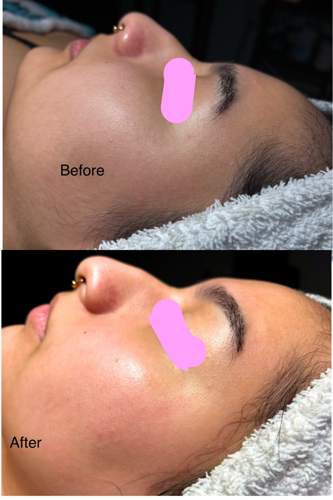 Dermaplaning