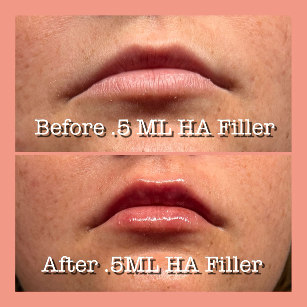 .5 ML NEEDLESS HA LIP FILLER at B.A.M. Beauty Bar in Bluff Dale, TX