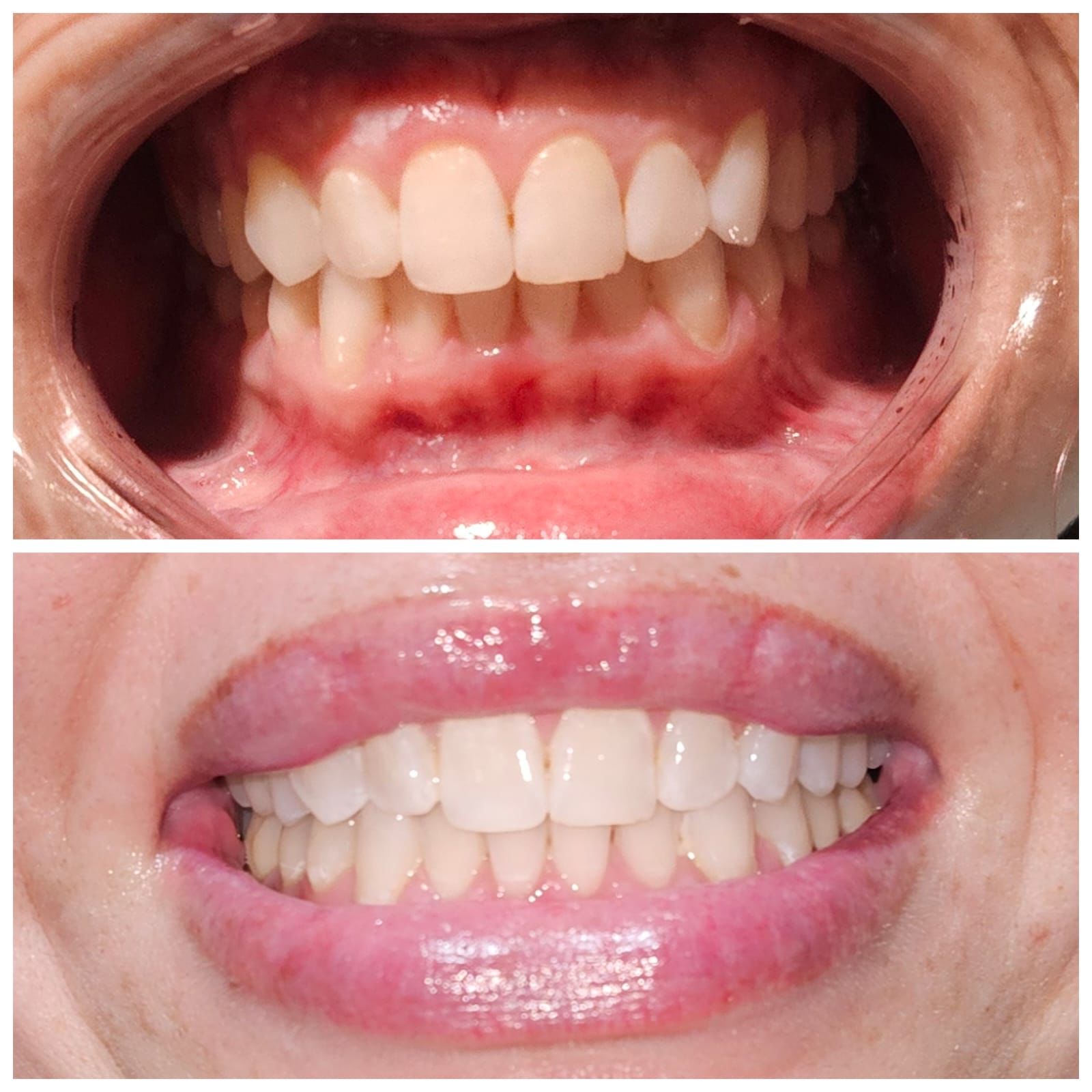 Suite Teeth Whitening