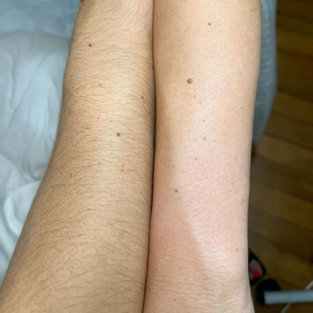 Full Arms Wax at LauLux Esthetics in Bellerose, NY