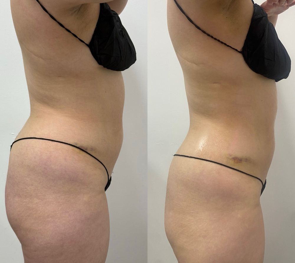 Snatch & Sculpt In-Home Treatment