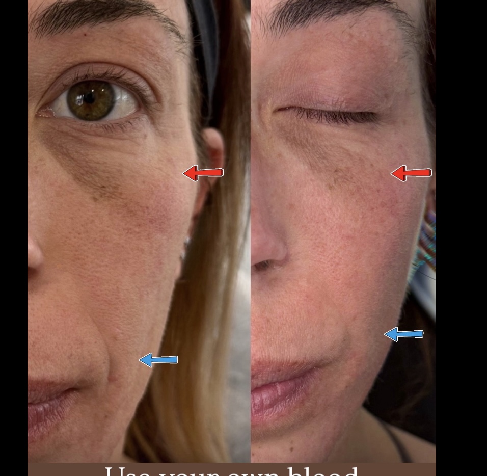 Plasma gel Nasal Labial Folds