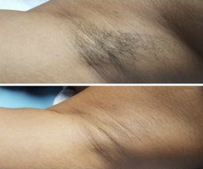 Underarm Wax