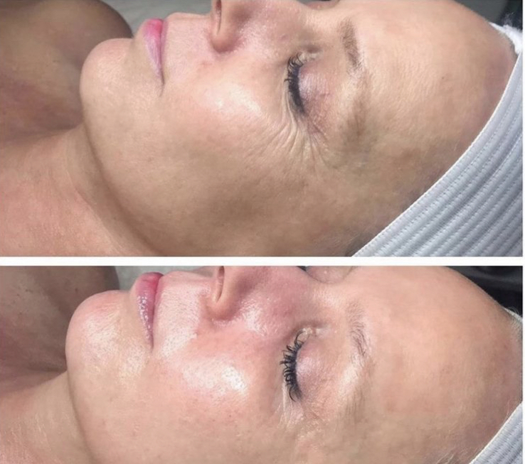 Anti Aging Facial