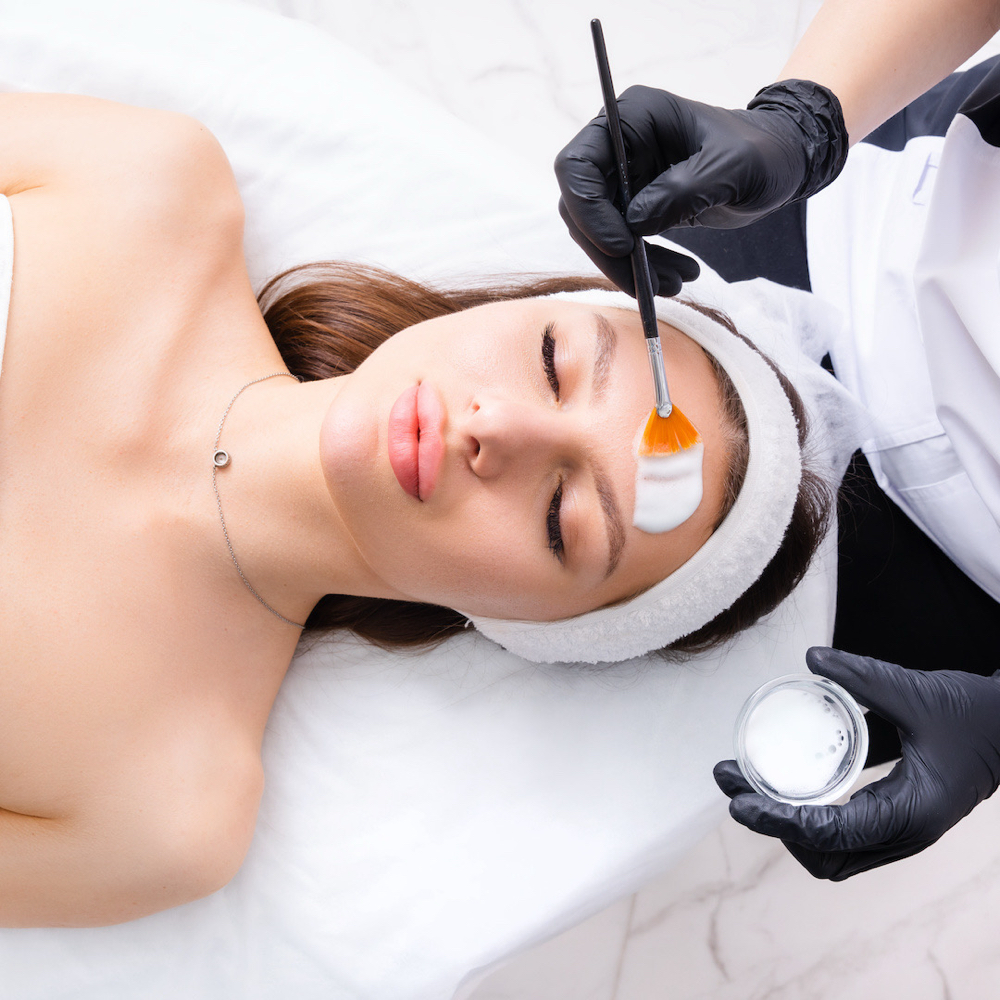 Chemical Peel