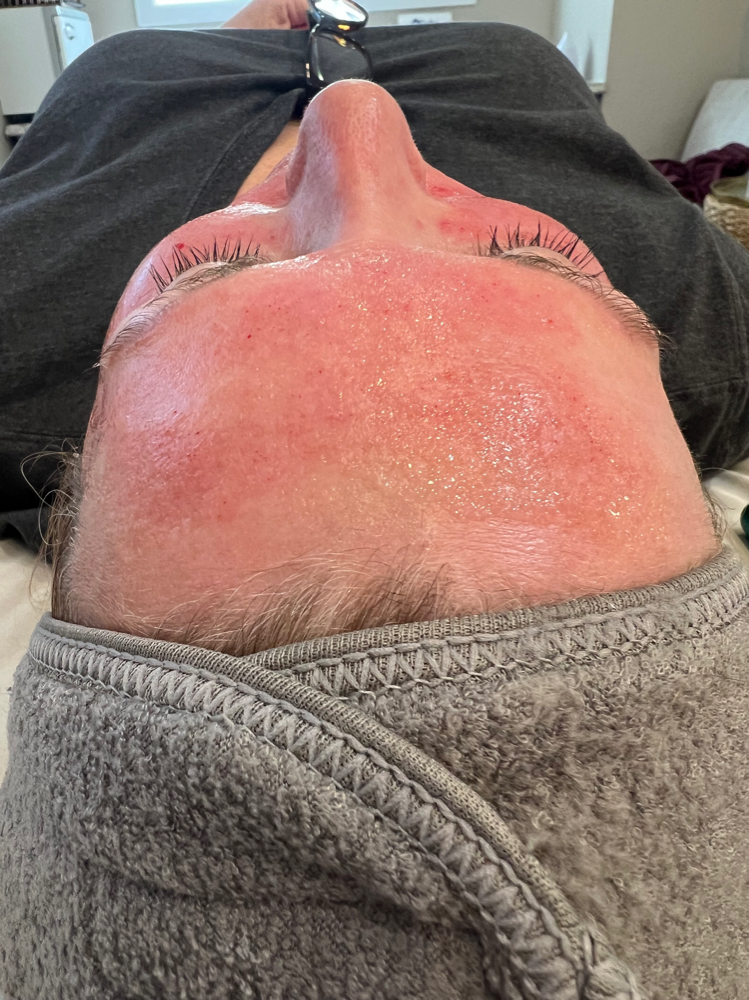 Microneedling at Elegant Esthetics By Jozlyn in Lamar, CO