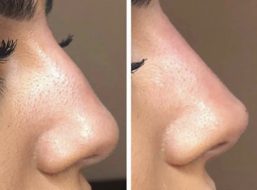 Nose Filler