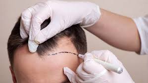 Scalp Pigmentation - Hairline