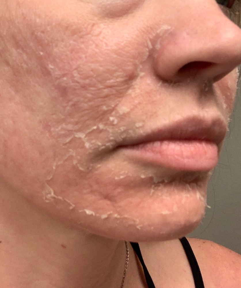 Downtime Peels