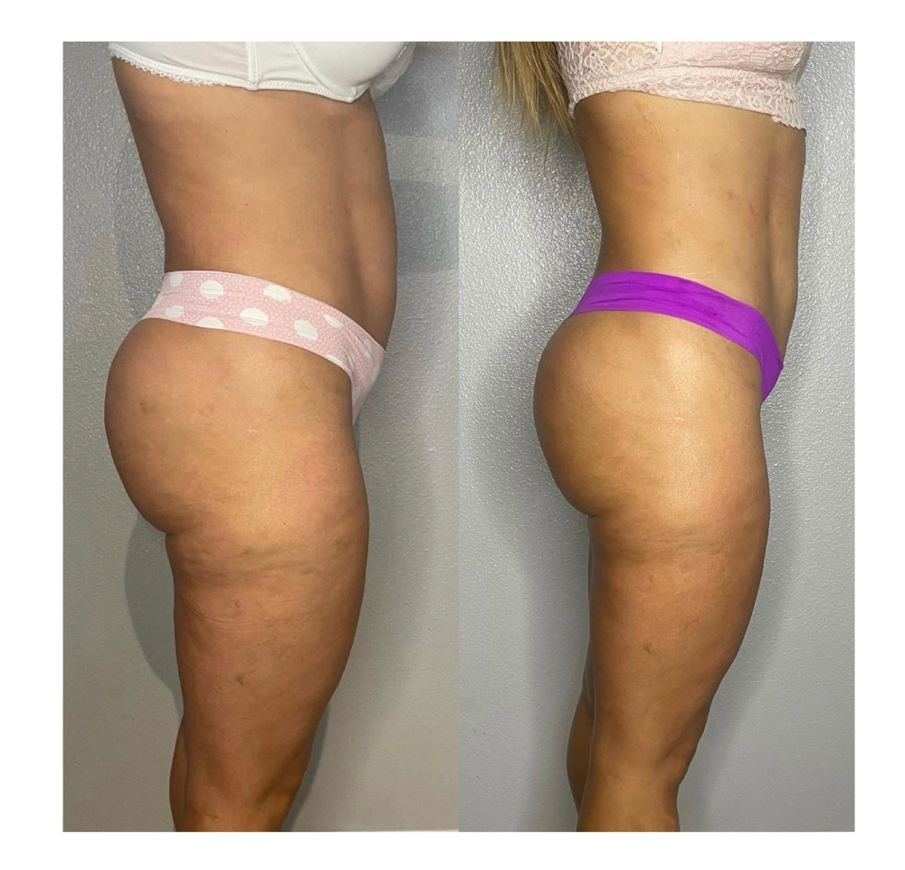 Body Sculpting 9 Sessions