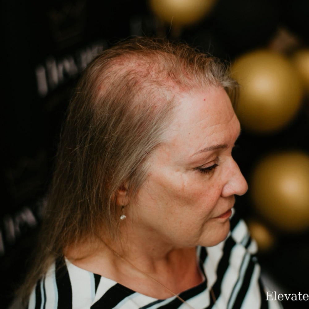 Hair Loss Consultation at Elev8ed Hair LLC. in Saint Augustine, FL