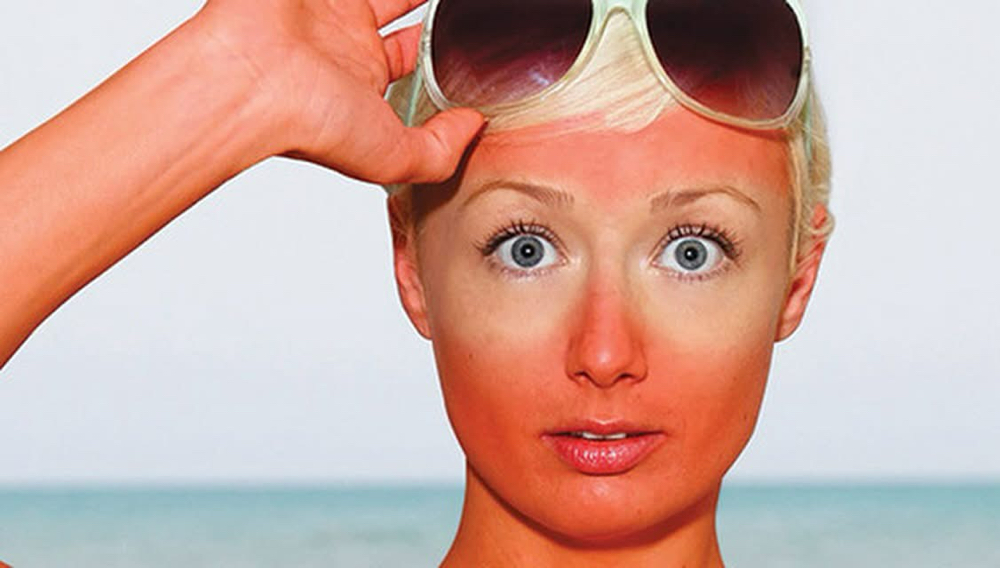 Sun Burn Rescue Facial