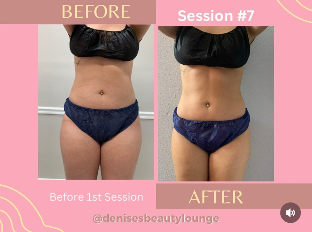 Body Sculpting