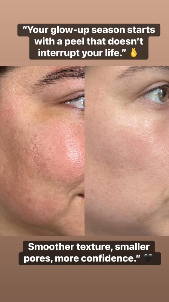 BioRePeel 💚 at Skin Perfection By Whitney in Zwolle, LA