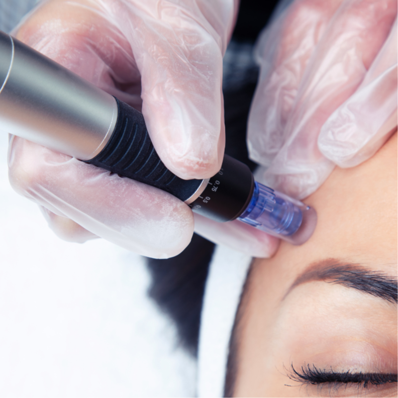 Nano Infusion at Skin + Soma Esthetics in National City, CA