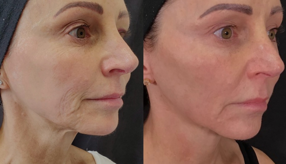 Face&Neck/ Rostro completo