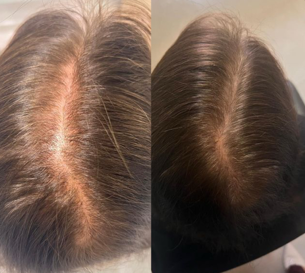 Hair Plasma