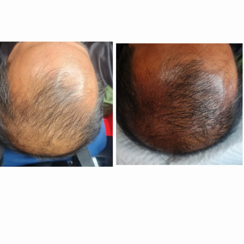 Scalp Pigmentation at Luxe Aesthetic & Wellness Center in Los Angeles, CA
