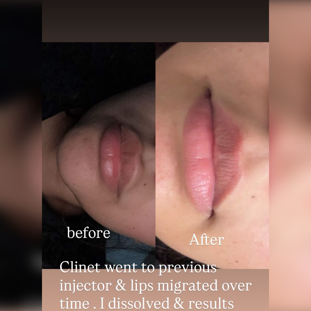 Migration filler Dissloving at AIKO AESTHETICS in Melrose Park, IL
