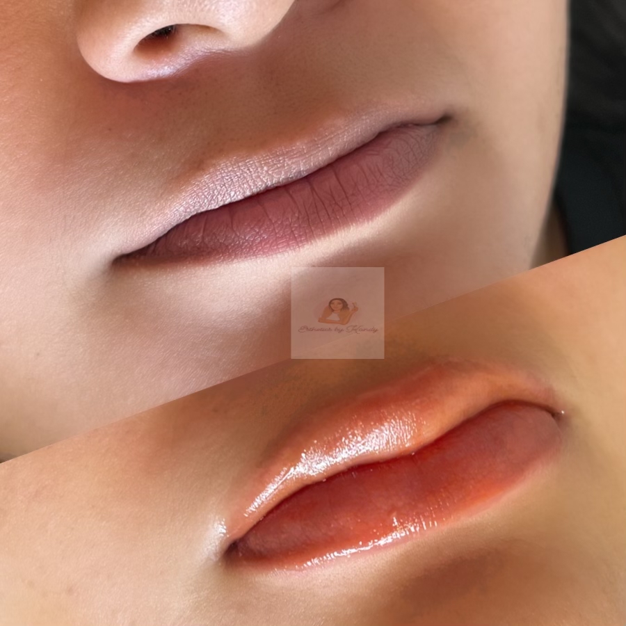 Lip Neutralization OR Lip Blush