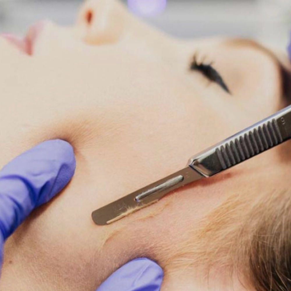 Dermaplane + peel at Filter Esthetics 30a in Miramar Beach, FL