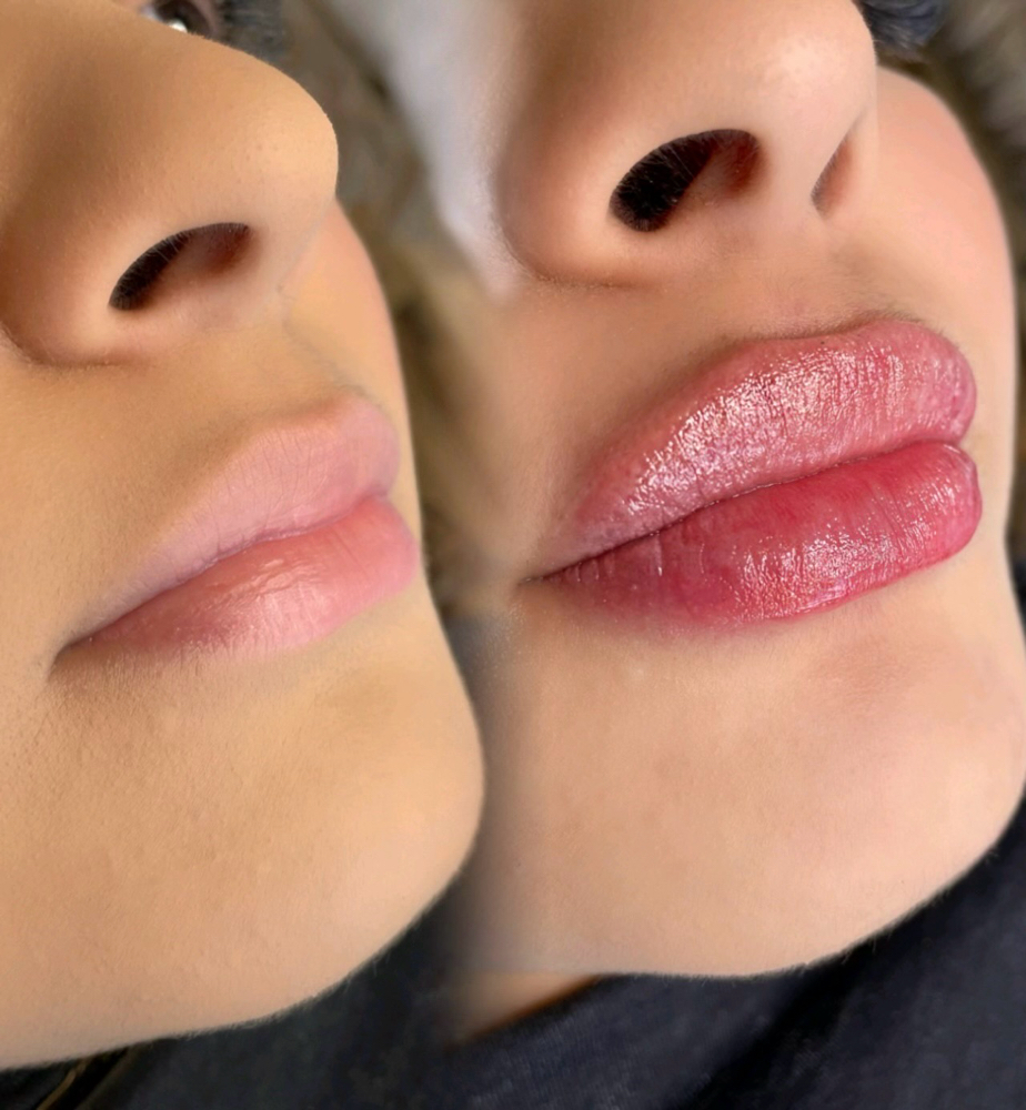 Needle-Less Lip Filler