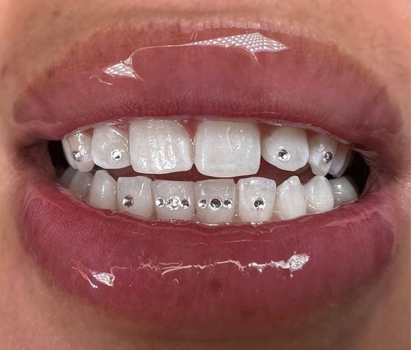 Each Additional Tooth Gem