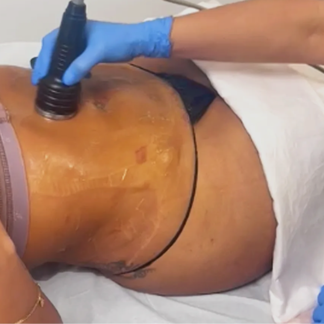 Post Op Lymphatic Drainage at Glo'Up Body Spa in Atlanta, GA