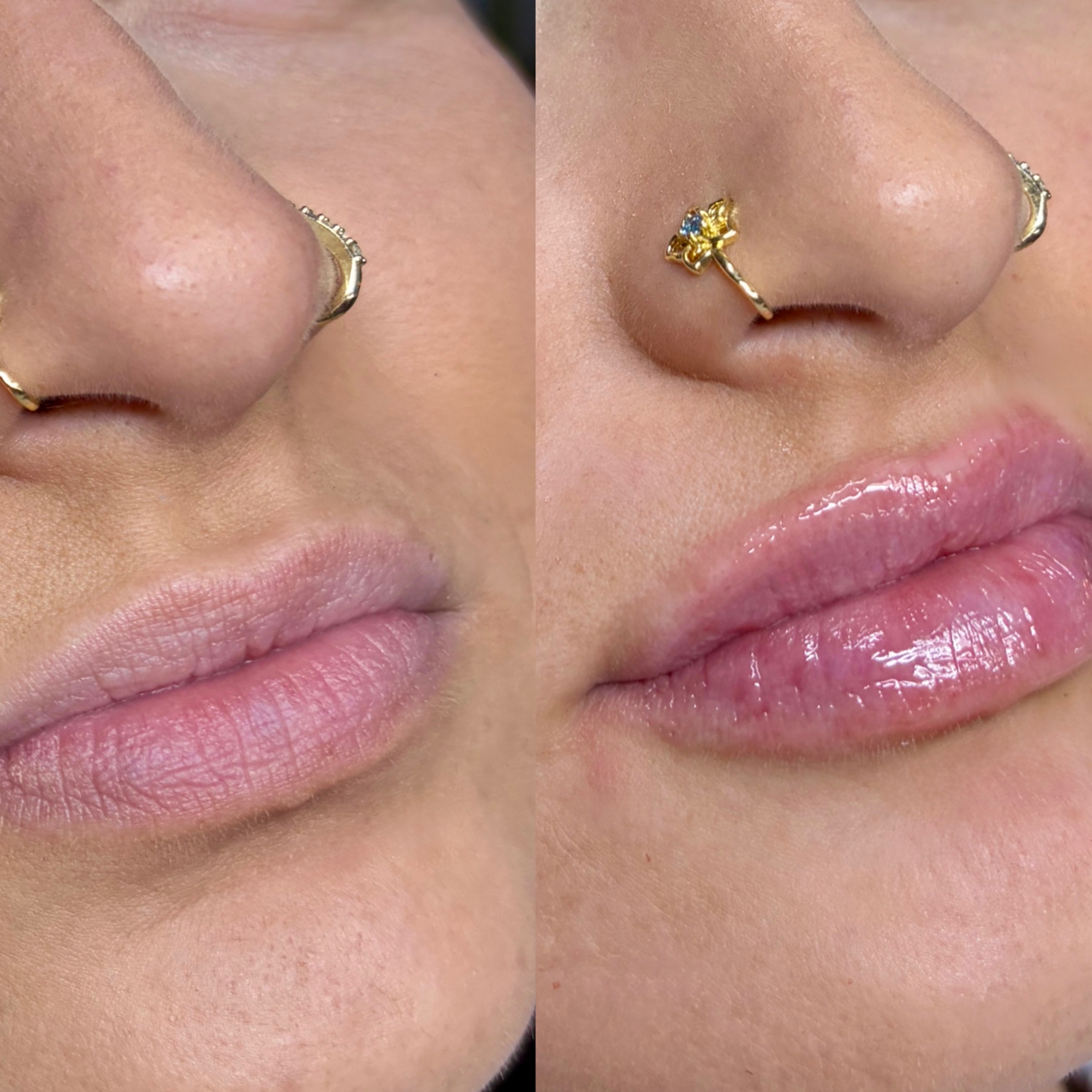 LEX LIPS | 1.0 at LEXTHETICS | Powered by Smiley Aesthetics & Dr. Katrina Briggs, MD in Columbus, OH