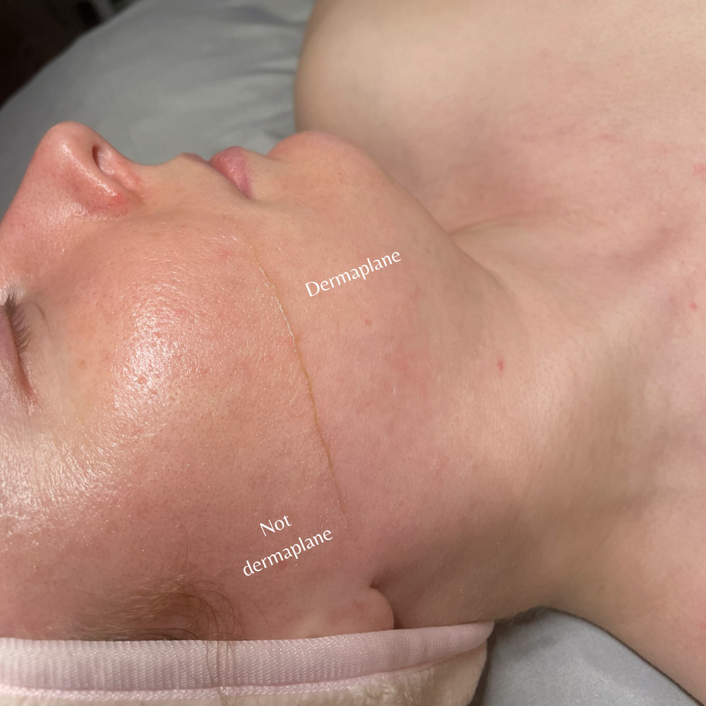 Dermaplane Facial