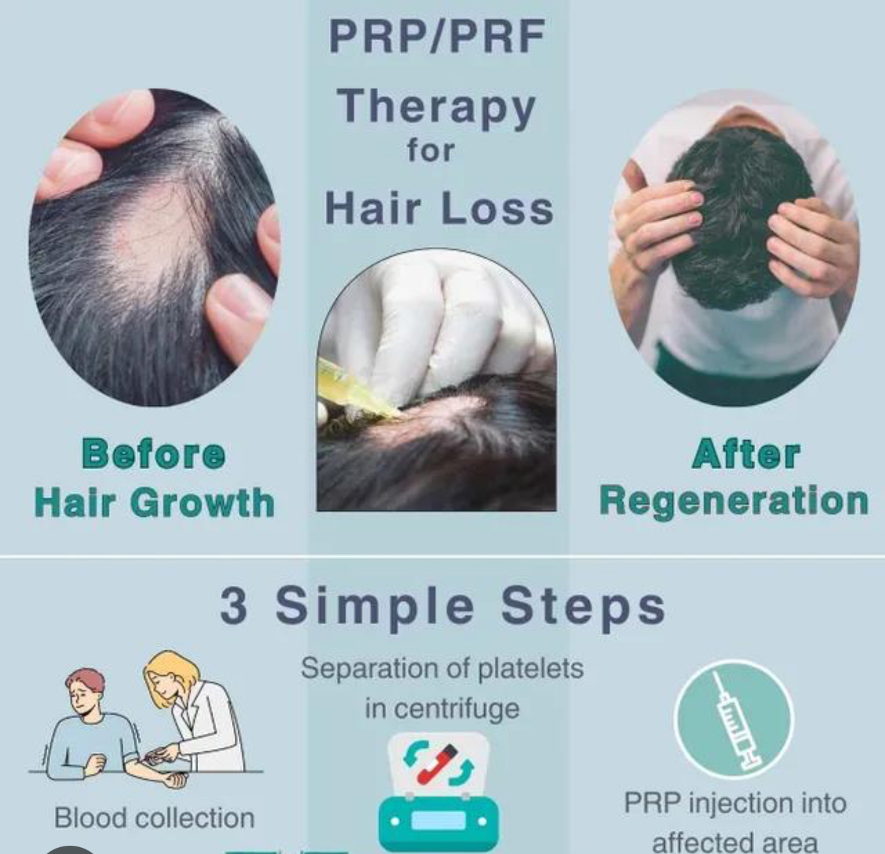 Hair Restoration using PRP