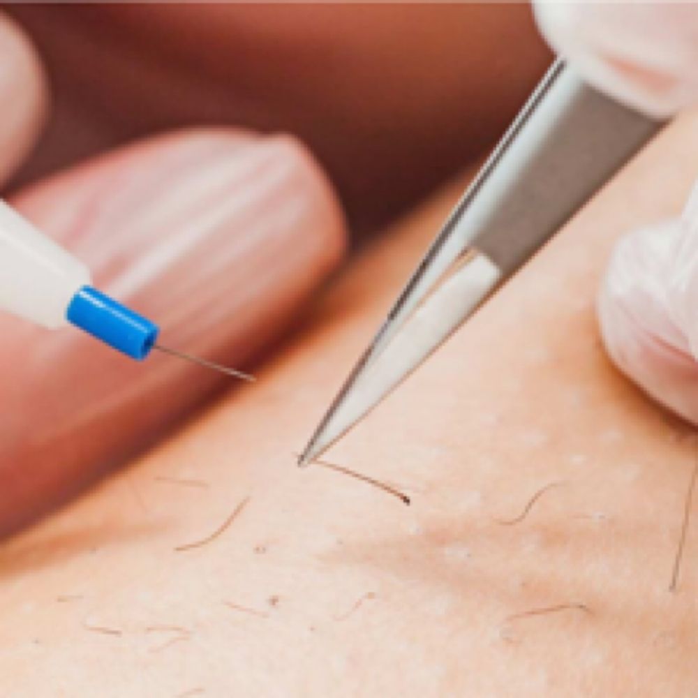 Electrolysis at Aura Electrolysis | Laser | Threading in Ashland, MA