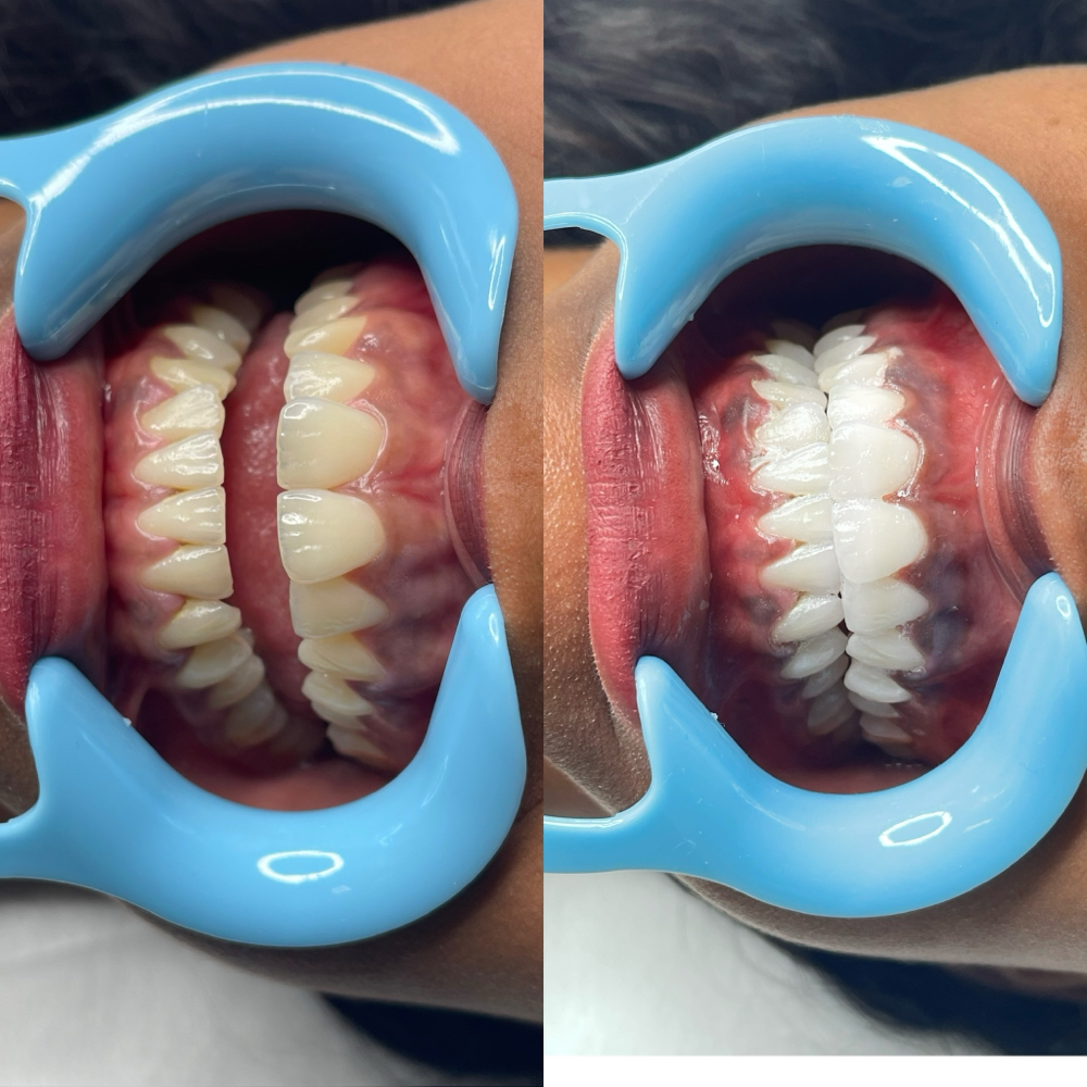 BLANQUEAMIENTO DENTAL