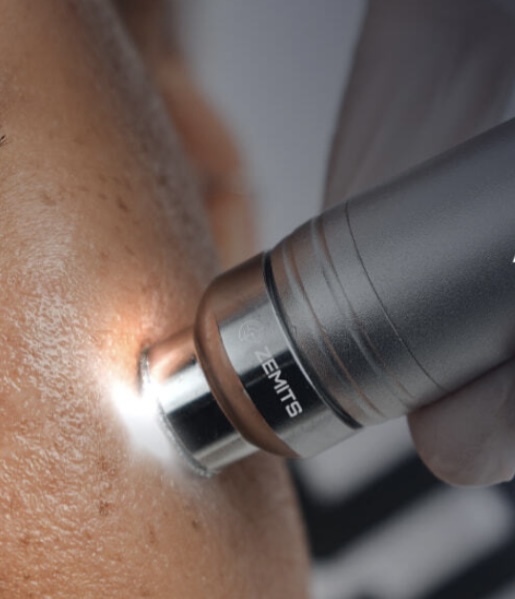 Diamond Microdermabrasion Facial