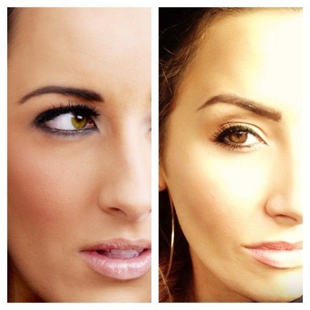 Brow Lift