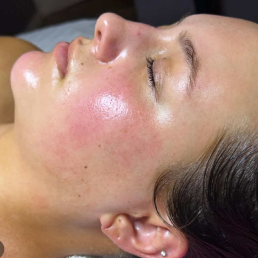 Acne Focused Facial at Peyton Bustamante in Harrisburg, IL