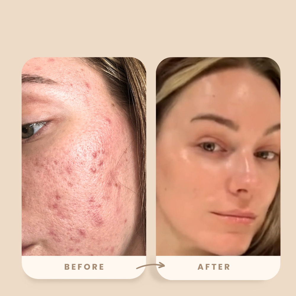 Acne Healing Program at Dose of Glow in Phoenix, AZ