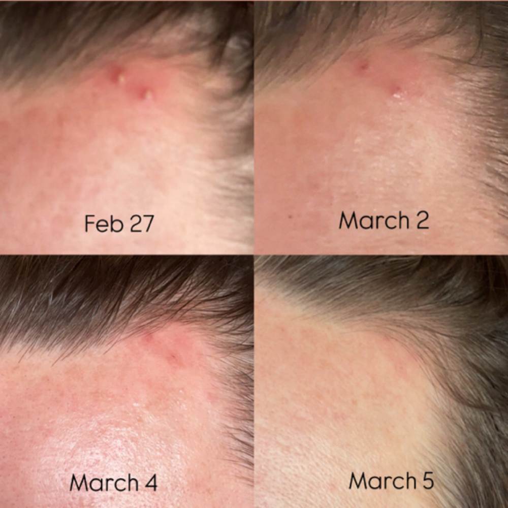 New Client Acne Program at Dose of Glow in Phoenix, AZ