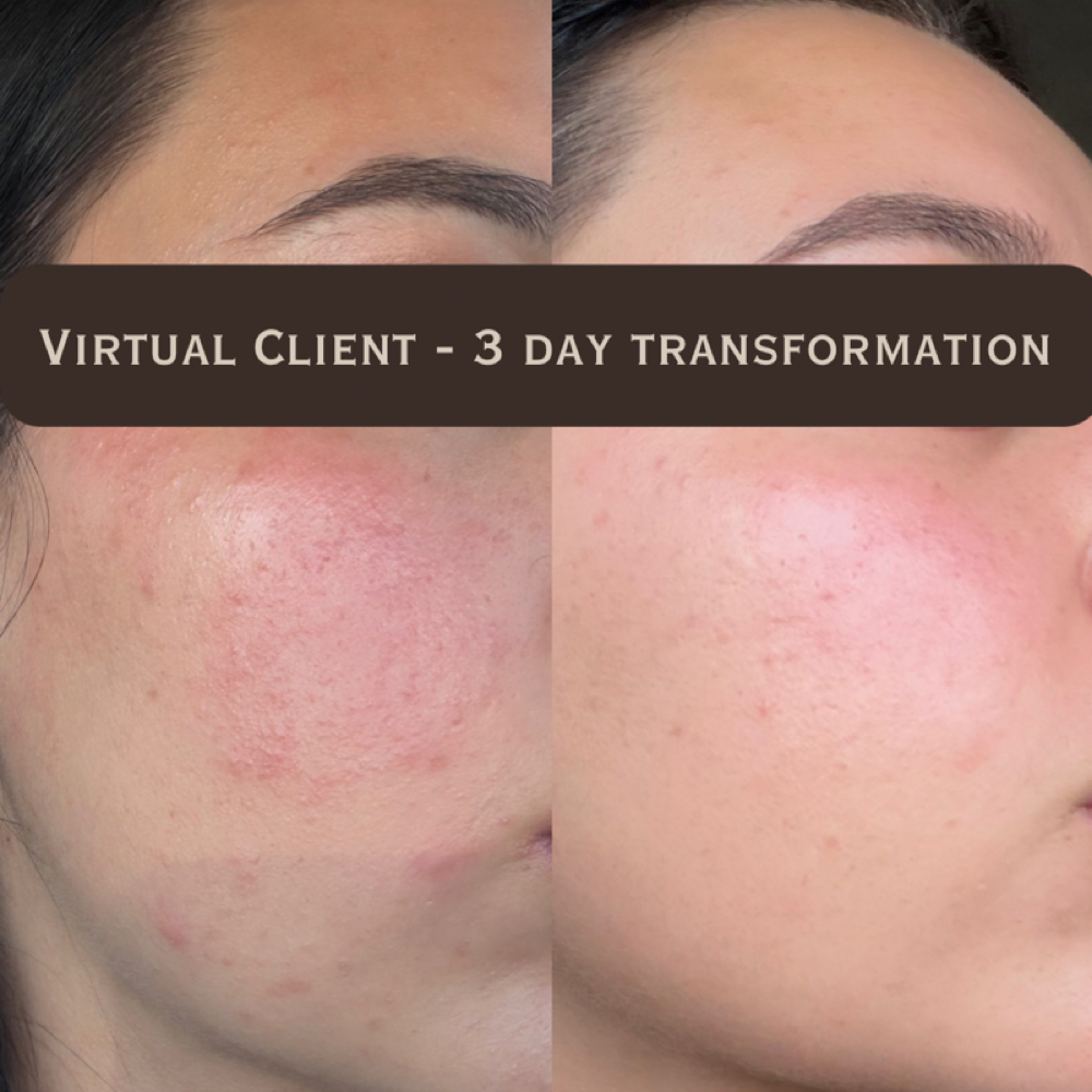 Acne Healing Program at Dose of Glow in Phoenix, AZ