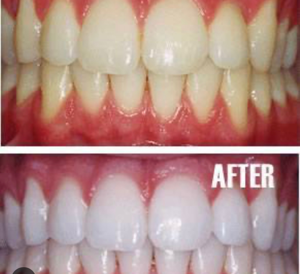 Professional Teeth Whitening