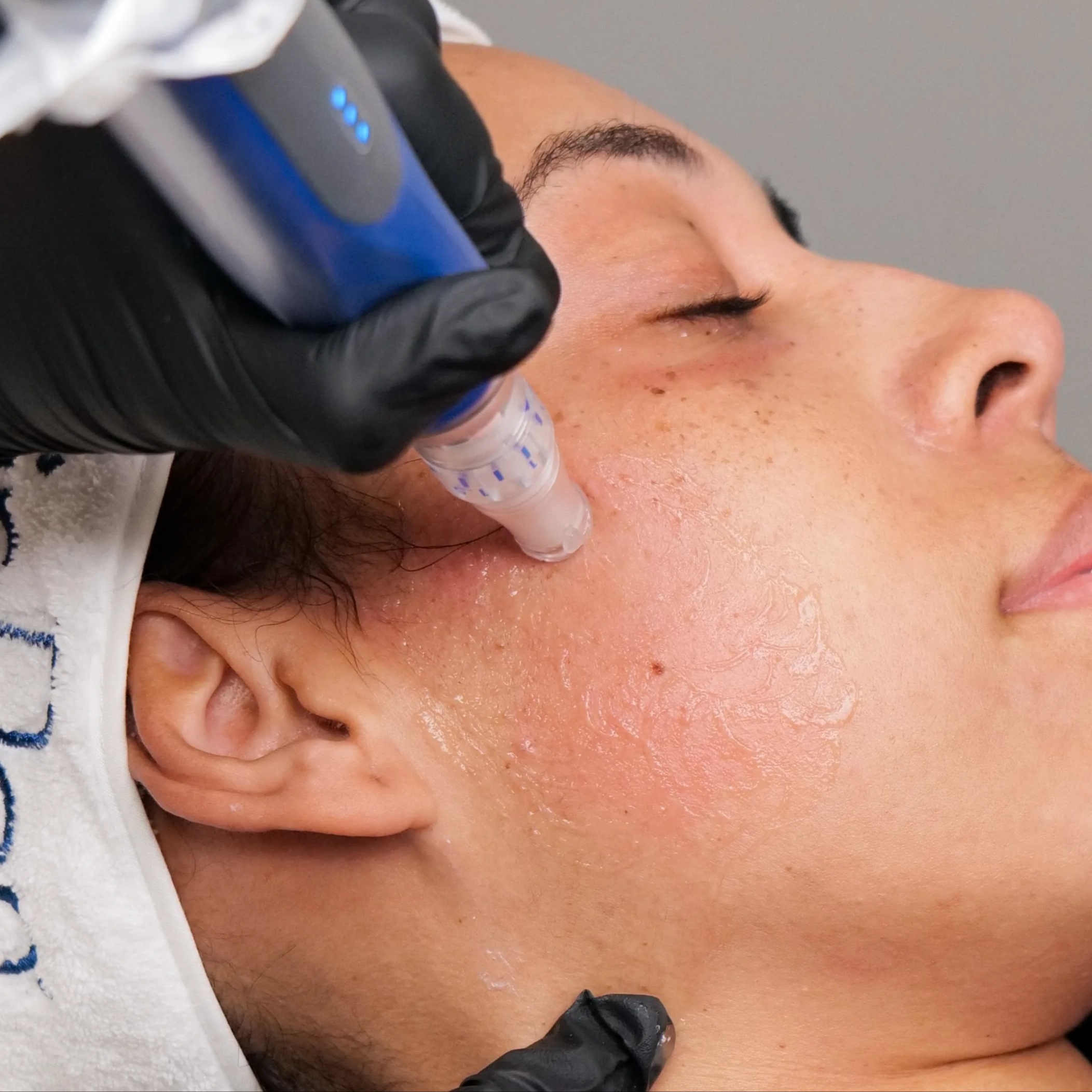 SkinPen Microneedle at Skin 4 Glow Inc in MOHEGAN LAKE, NY