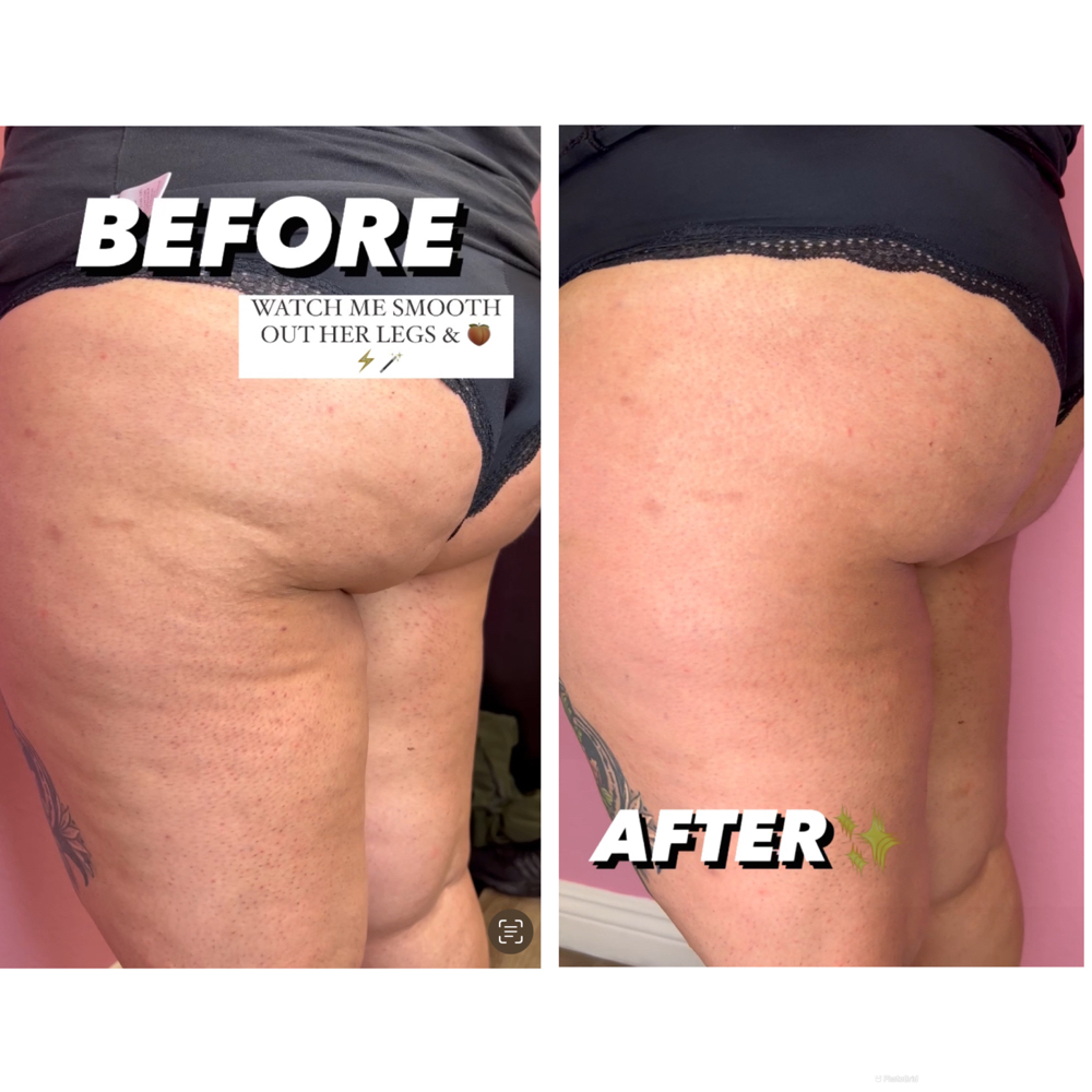 Cellulite Treatment