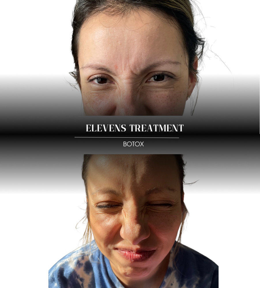 Botox